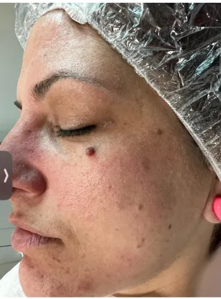 Skin Tags in Marlborough, MA