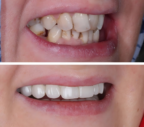 Veneers vs. Bonding: Which Artistic Choice is Yours?