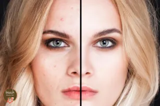Introducing ProCell Microchanneling: The Future of Skin Rejuvenation