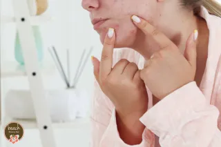 Should You Pop Your Pimples?