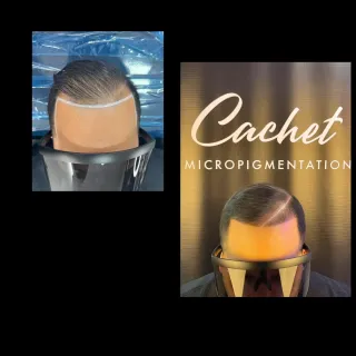 Scalp Micropigmentation Before and After Cachet Scalp Micropigmentation