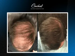 How Hair Fibers Work to Camouflage Hair Loss: Are They Right for You?