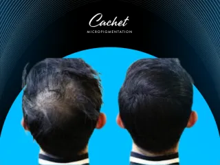 Temporary vs. Permanent Solutions to Camouflage Hair Loss | Cachet SMP
