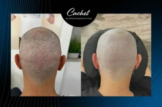 Discover the Latest Hair Transplant Scar Revision Techniques and Advancements