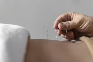 Needle Away Your Pain: Exploring Dry Needling Therapy at NJRE