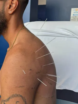 Discover the Benefits of Needle Therapy Near You: A Comprehensive Guide to Healing and Wellness