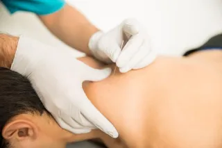 Dry Needling: A Powerful Therapy for Pain Relief and Recovery