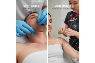 Dry Needling vs. Acupuncture: Key Differences You Should Know
