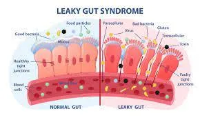 How Do I Know if I Have a Leaky Gut?