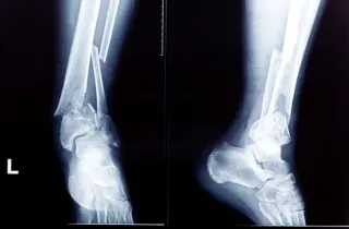 Breaking News for Broken Bones: You Could--And Should Walk Sooner After a Fracture