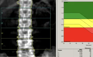 It Improved My Bone Density—Something I Didn't See Coming