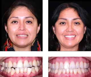 What to Expect During Your Invisalign Treatment Journey