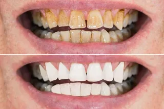 Teeth Cleaning and Polishing: Essential Care for a Bright and Healthy Smile
