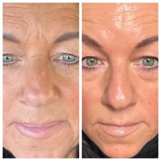 Nonsurgical Nose Job with Fibroblast