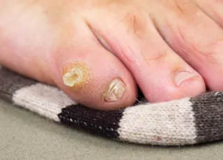 Don’t Let Corns Slow You Down: Simple Solutions for Smooth Feet!