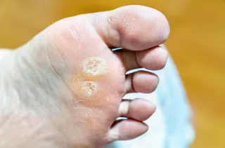 Callouses Be Gone: Tips for Prevention and Smooth Skin