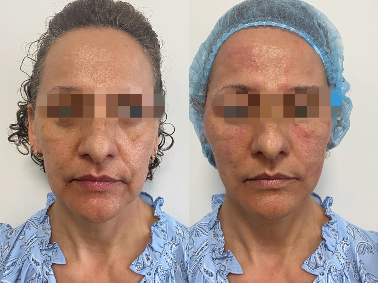 Thread Lift in Monterey Park, CA | Non-Surgical Facelift