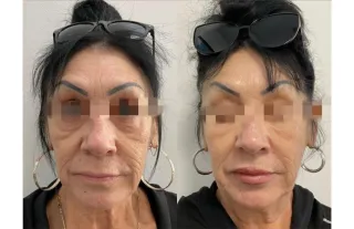 Morpheus8 Skin Tightening in Monterey Park, CA