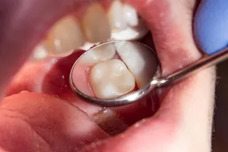Affordable Emergency Dental Care in Boise | Payment Plans & Discounts