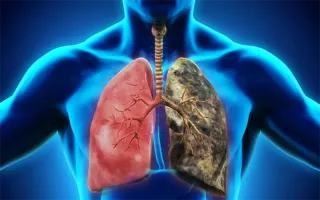 Những vấn đề về ung thư phổi bạn cần nắm rõ