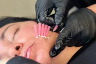 PDO Threading: The Non-Surgical Face Lift