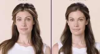 Baby Botox: The Subtle Way to Stay Fresh and Fabulous