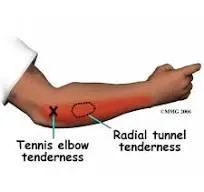 Fixing Tennis Elbow Without Shots/Surgery