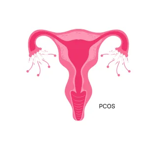 Understanding the Exercise Guidelines for PCOS