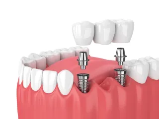 Do Dental Implants Last Forever? Debunking Myths and Realistic Expectations