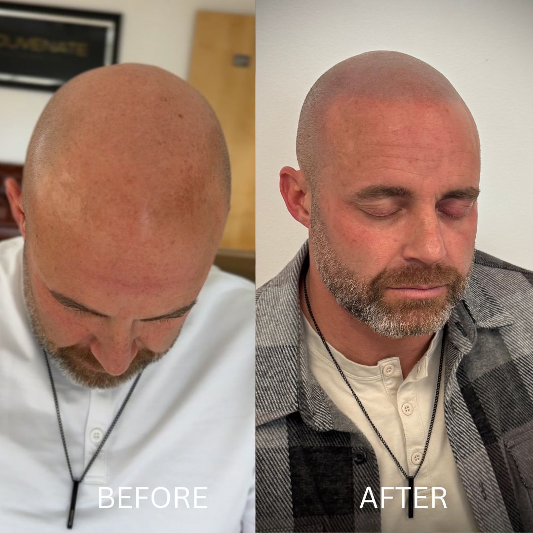 Hairline Restoration