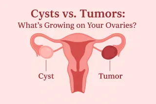 Cysts vs. Tumors: What’s Growing on Your Ovaries?