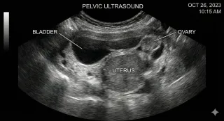 What to Expect During a Pelvic Ultrasound: A Gentle Guide for Women Who Are Nervous