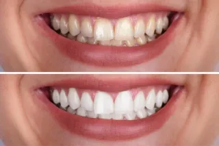 Light Up Your Smile: Unlock the Power of Teeth Whitening