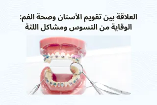 العلاقة بين تقويم الأسنان وصحة الفم: الوقاية من التسوس ومشاكل اللثة