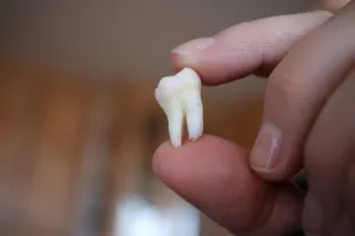 How To Know If Wisdom Teeth Should Be Removed