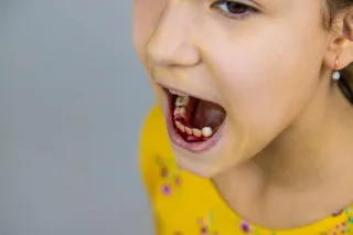 Knocked-Out Tooth? Save Your Child's Smile (Quick Guide)