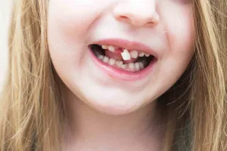 Cracked Tooth Crisis: A Parent’s Guide to Treatment