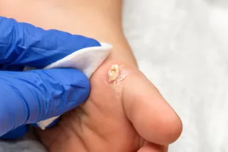 Understanding Verrucas: Causes, Symptoms, and Effective Relief in Pomona