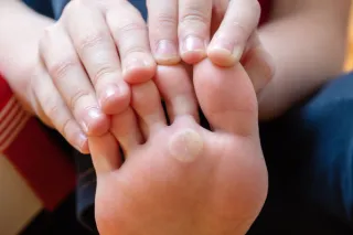 Verruca or Wart? Clarifying the Difference and How to Treat Them in Pomona