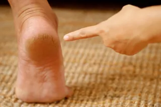 Is Cracked Heel Skin Just a Cosmetic Issue?