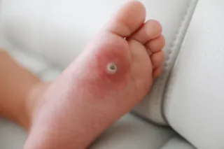 Why Do Warts Keep Coming Back? SWIFT Can Help Stop the Cycle