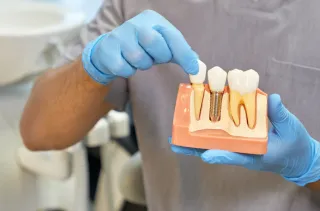 How Much Do Dental Implants Cost?