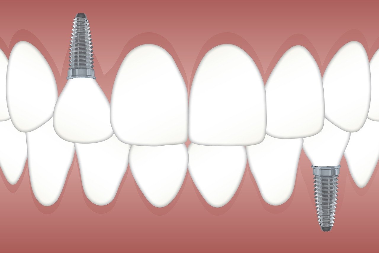 Dental Implants Explained: A Comprehensive Overview