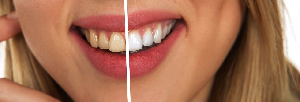 Transform Your Smile with Expert Teeth Whitening in Temecula, CA