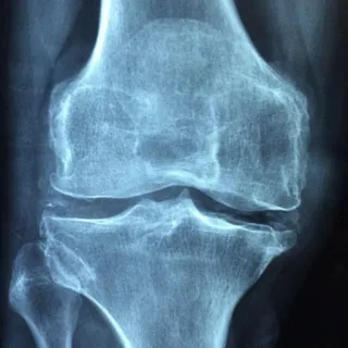 Preventing Osteoporosis – What You Must Know