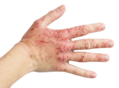 Relief from Raw Skin - BICOM® Case Study