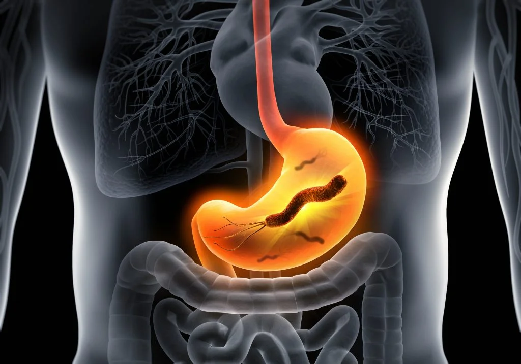 A Patient's Successful Battle with H Pylori
