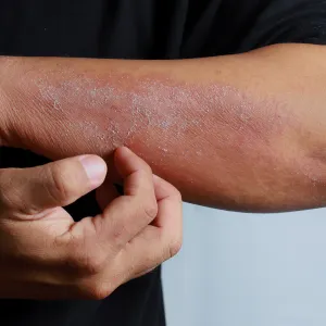 Bioresonance Therapy And Atopic Eczema
