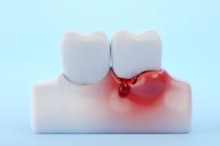 Ce să faci dacă observi sângerări frecvente ale gingiilor și cum poate ajuta un medic stomatolog?