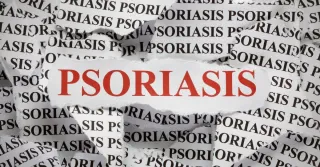 Aerolase for Psoriasis: Clearer Skin Without Harsh Treatments

